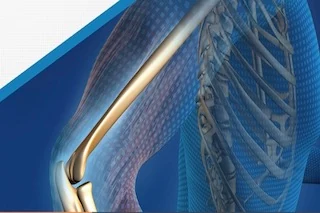 An Overview of the Classification and Development Status of Bone Graft Materials