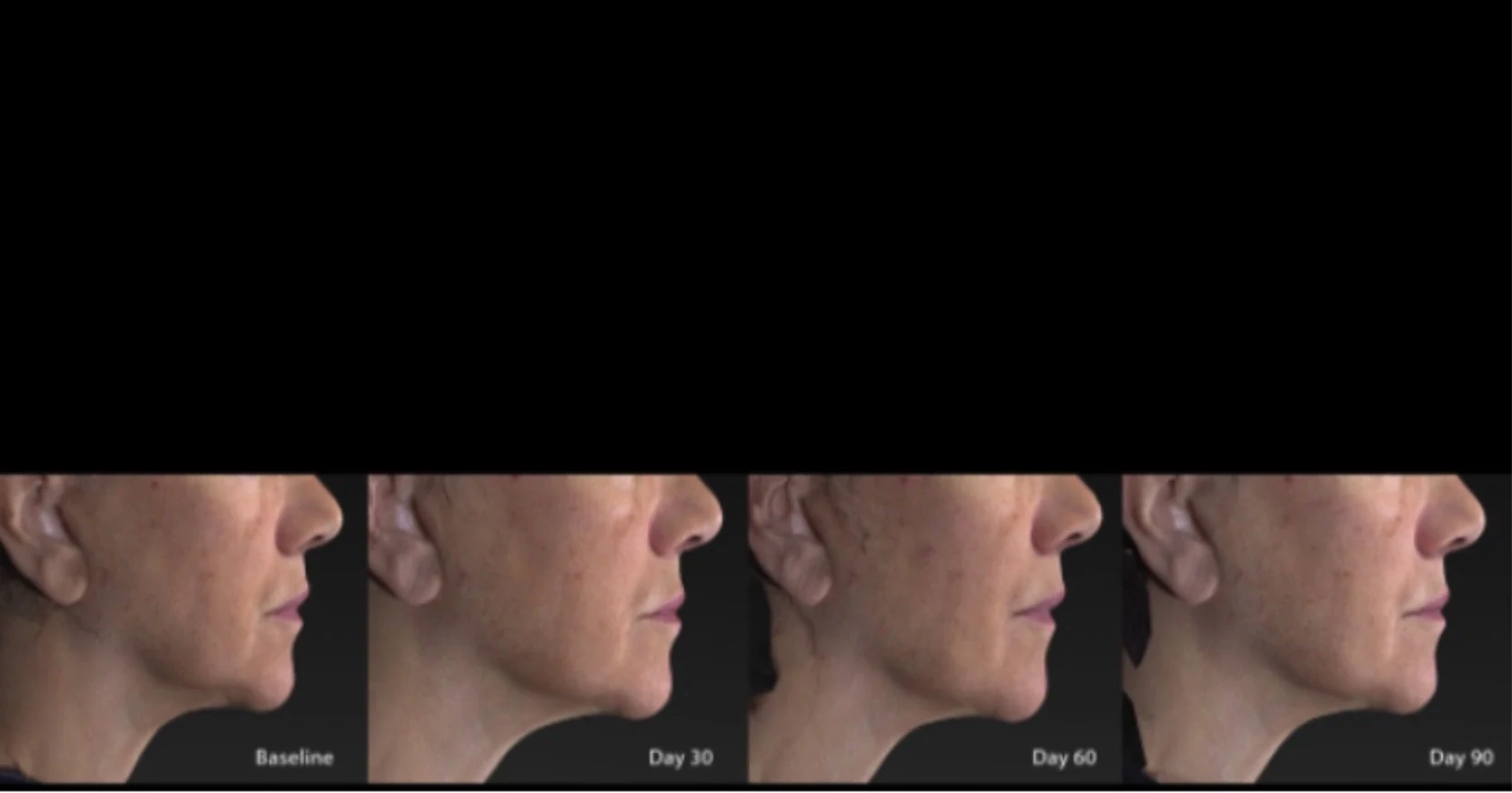 Short-Term Research Shows Hydroxyapatite Can Achieve Safe and Effective Mandibular Augmentation