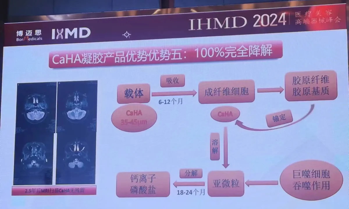 关于羟基磷灰石的100%降解（来自 IHMD 分享）